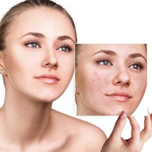 Les bienfaits de l'acide mandélique pour la peau