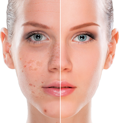 éclaircissantes pour les taches brunes